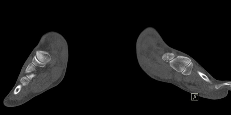 File:Calcaneal fractures with associated L2 burst fracture (Radiopaedia 71671-82041 Coronal bone window 32).jpg