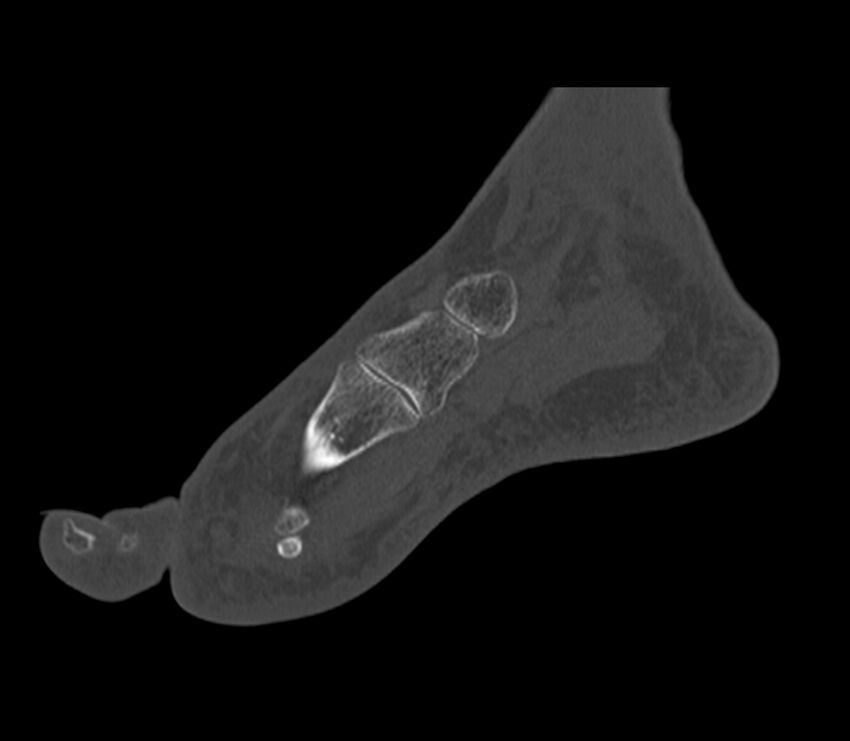Calcaneal tuberosity avulsion fracture (Radiopaedia 22649-22668 Sagittal bone window 39).jpg