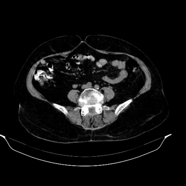 File:Calcified hydatid cyst (Radiopaedia 62000-70085 Axial non-contrast 71).jpg