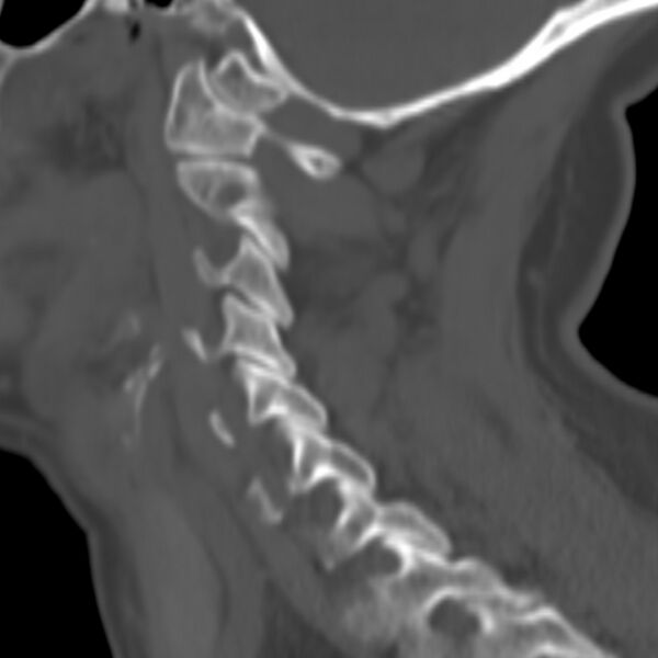 File:Calcified meningioma - cervical canal (Radiopaedia 70136-80171 Sagittal bone window 3).jpg