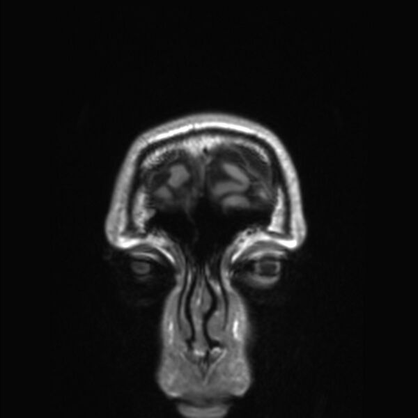 File:Callosal dysgenesis with interhemispheric cyst (Radiopaedia 53355-59335 Coronal T1 183).jpg
