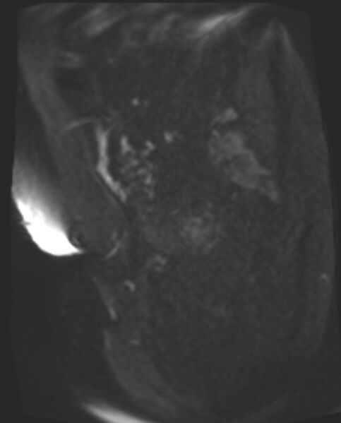 File:Cancer cervix - stage IIb (Radiopaedia 75411-86615 Sagittal DWI 68).jpg