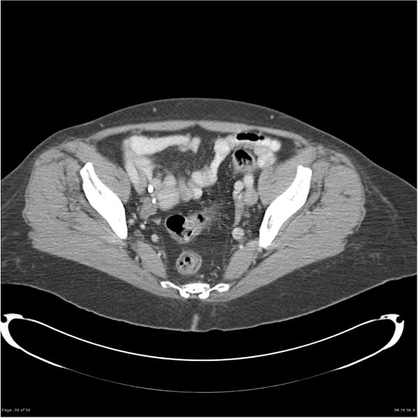 File:Carcinoid tumor of the ileum with metastasis to orbit (Radiopaedia 28165-28425 A 30).jpg