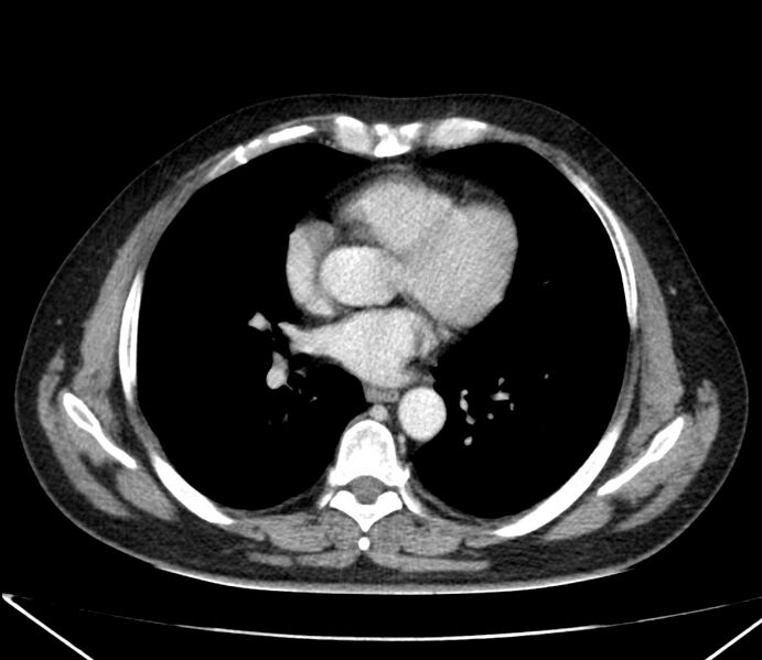 File:Carcinoid tumor with hepatic metastases (Radiopaedia 22651-22670 C 20).jpg