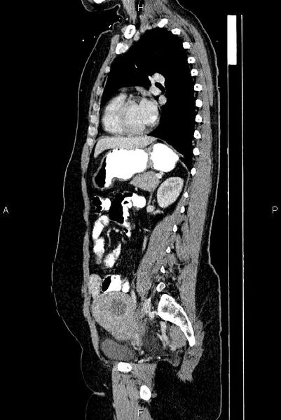 File:Carcinoma of uterine cervix (Radiopaedia 85861-101700 D 53).jpg