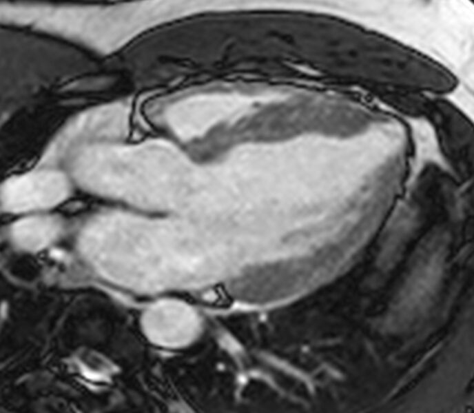 File:Cardiac sarcoidosis (Radiopaedia 39811-42243 LVOT cine images 15).jpg