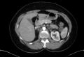 Cardiac sarcoidosis (Radiopaedia 74548-85534 A 100).jpg