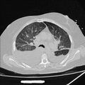 Cardiogenic pulmonary edema (Radiopaedia 29213-29609 Axial lung window 34).jpg