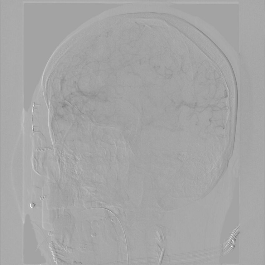 Caroticocavernous fistula - direct (Radiopaedia 61660-69666 Oblique Left ICA 31).jpg