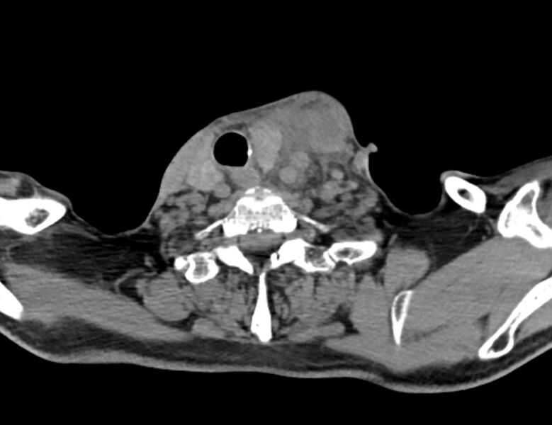 File:Carotid artery pseudoaneurysm (Radiopaedia 84030-99259 Axial non-contrast 44).jpg