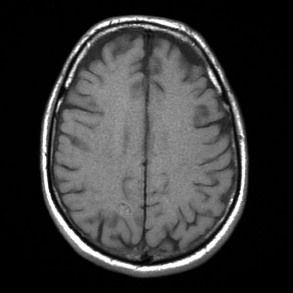 File:Cavernous hemangioma - brain (Radiopaedia 9773-10378 Axial T1 1).jpg