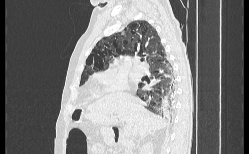 File:Cavitating bronchogenic carcinoma (Radiopaedia 44489-48162 Sagittal lung window 20).jpg