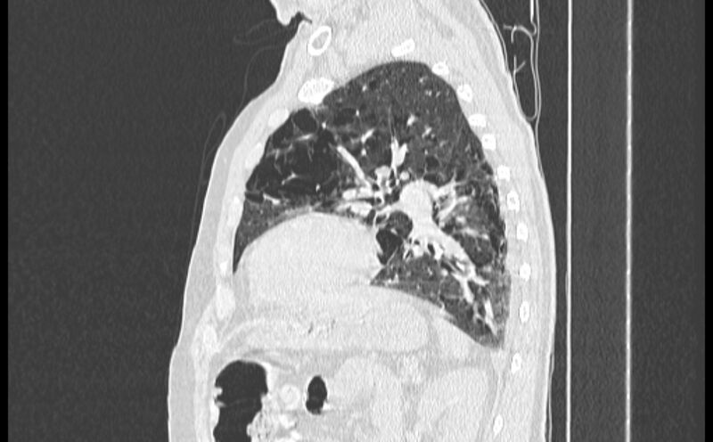 File:Cavitating bronchogenic carcinoma (Radiopaedia 44489-48162 Sagittal lung window 46).jpg