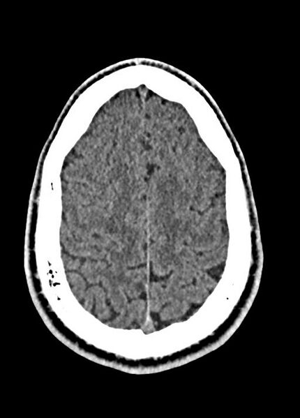 File:Cavum septum pellucidum and cavum vergae (Radiopaedia 77797-90060 Axial Brain Window 84).jpg
