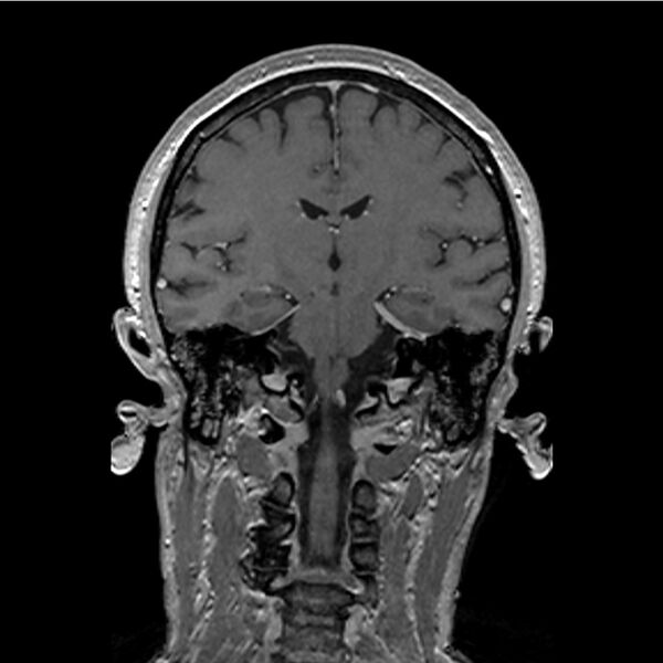 File:Central base of skull meningioma (Radiopaedia 53531-59549 Coronal T1 C+ 27).jpg