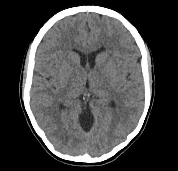 File:Cerebellar agenesis (Radiopaedia 30203-30817 Axial non-contrast 22).jpg
