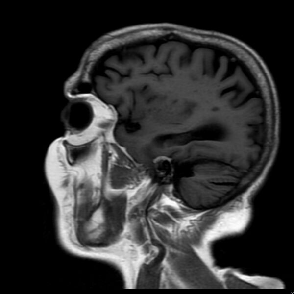 File:Cerebellar ataxia with neuropathy and vestibular areflexia syndrome (CANVAS) (Radiopaedia 74283-85159 Sagittal FLAIR 16).jpg