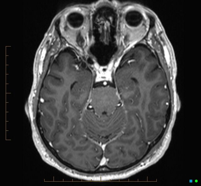 File:Cerebellar gangliocytoma (Radiopaedia 65377-74422 Axial T1 C+ 43).jpg
