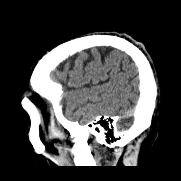 File:Cerebellar hemorrhage (Radiopaedia 27193-27359 C 8).jpg