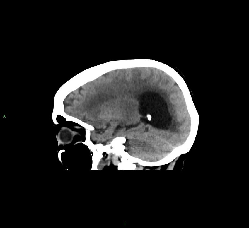 Cerebellar hemorrhage (Radiopaedia 58793-66027 C 35).jpg