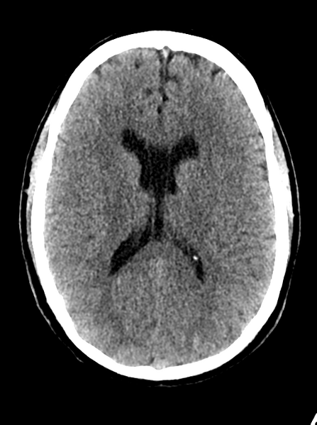 File:Cerebellar infarct due to vertebral artery dissection with posterior fossa decompression (Radiopaedia 82779-97032 Axial non-contrast 17).png