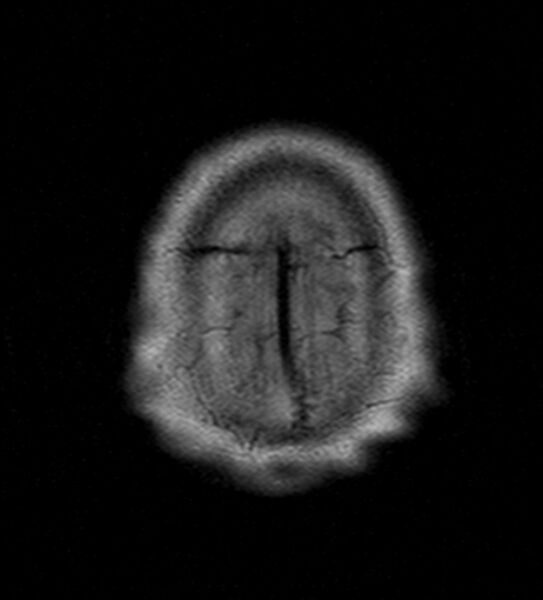 File:Cerebellopontine angle meningioma (Radiopaedia 24459-24764 Axial FLAIR 24).jpg