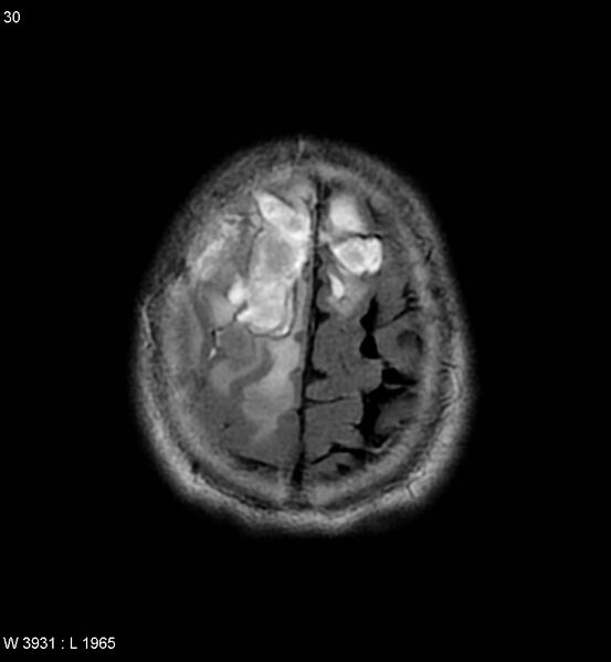 File:Cerebral abscesses secondary to contusions (Radiopaedia 5201-6968 Axial FLAIR 9).jpg