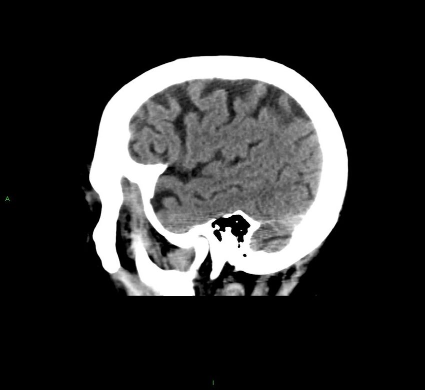 Cerebral amyloid angiopathy-associated lobar intracerebral hemorrhage (Radiopaedia 58376-65511 C 11).jpg