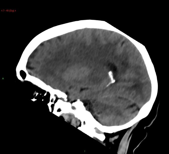File:Cerebral amyloid angiopathy-associated lobar intracerebral hemorrhage (Radiopaedia 58378-65518 C 40).jpg