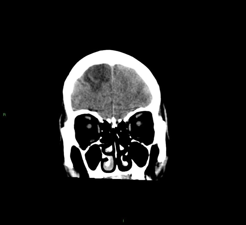 Cerebral amyloid angiopathy-associated lobar intracerebral hemorrhage (Radiopaedia 58529-65681 Coronal non-contrast 54).jpg