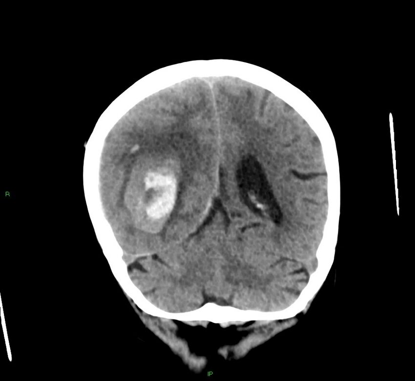 Cerebral amyloid angiopathy-associated lobar intracerebral hemorrhage (Radiopaedia 58563-65727 Coronal non-contrast 23).jpg