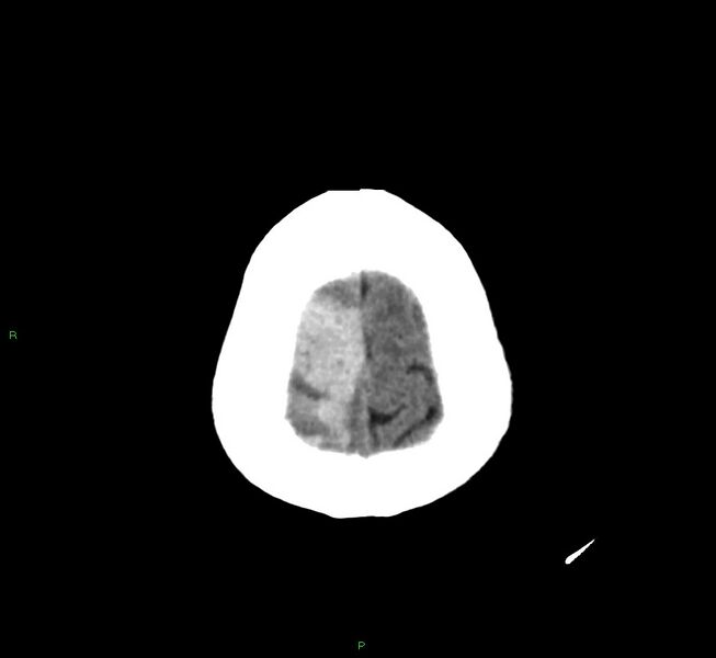 File:Cerebral amyloid angiopathy-associated lobar intracerebral hemorrhage (Radiopaedia 58751-65972 Axial non-contrast 6).jpg