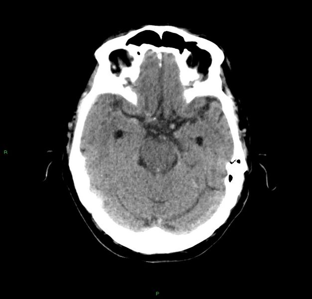 File:Cerebral amyloid angiopathy-associated lobar intracerebral hemorrhage (Radiopaedia 59356-66716 Axial non-contrast 31).jpg