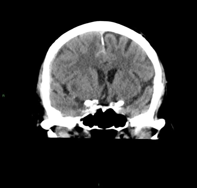 File:Cerebral amyloid angiopathy-associated lobar intracerebral hemorrhage (Radiopaedia 59356-66716 Coronal non-contrast 42).jpg
