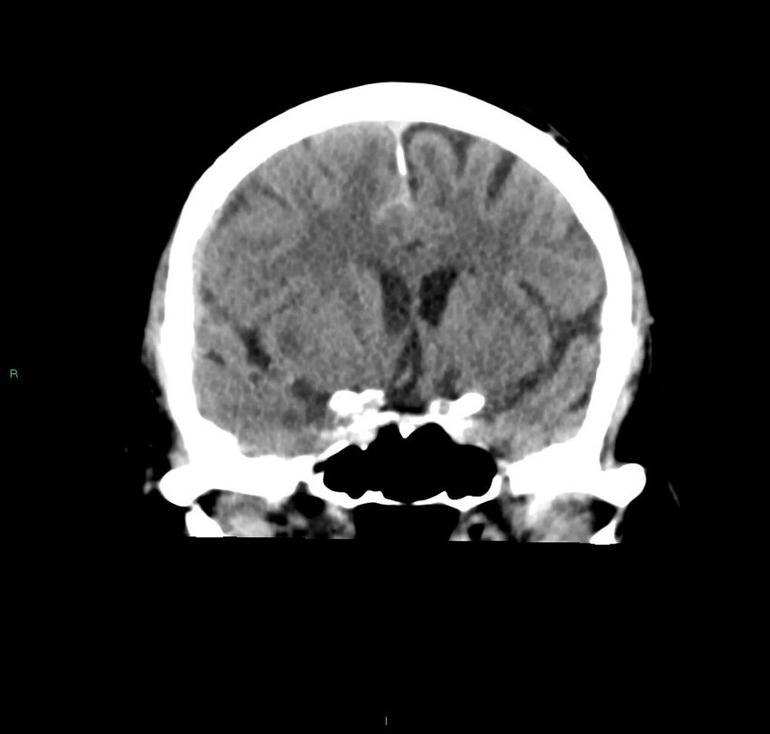Cerebral amyloid angiopathy-associated lobar intracerebral hemorrhage (Radiopaedia 59356-66716 Coronal non-contrast 42).jpg