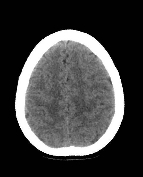 File:Cerebral edema due to severe hyponatremia (Radiopaedia 89826-106938 Axial non-contrast 81).jpg
