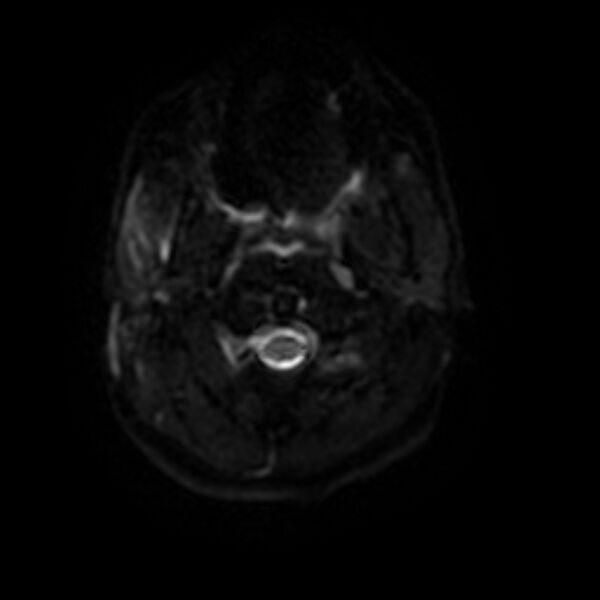 File:Cerebral fat embolism (Radiopaedia 37510-39363 Axial DWI 24).jpg