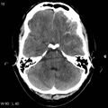 Cerebral hemorrhagic contusion with subdural and subarachnoid hemorrhage (Radiopaedia 10680-11146 Axial non-contrast 7).jpg