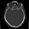 Cerebral hemorrhagic contusions (Radiopaedia 23145-23188 Axial bone window 20).jpg