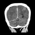 Cerebral hemorrhagic contusions (Radiopaedia 23145-23188 Coronal non-contrast 34).jpg