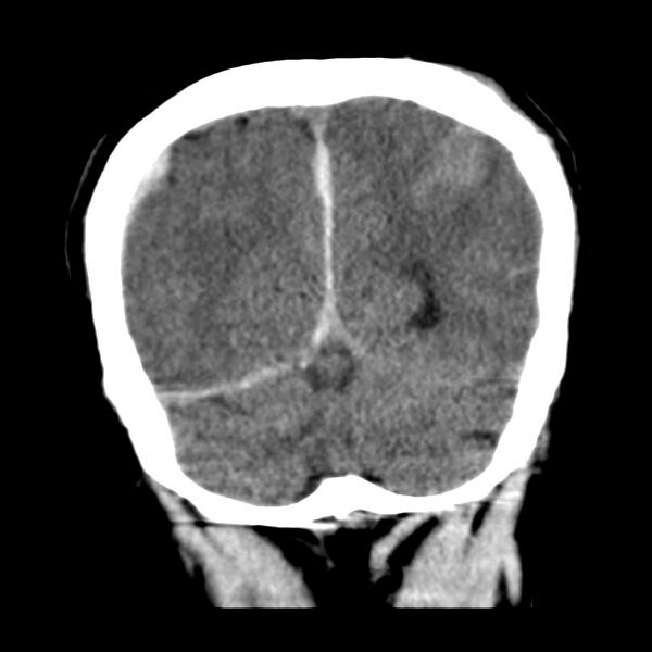 File:Cerebral hemorrhagic contusions (Radiopaedia 23145-23188 Coronal non-contrast 34).jpg