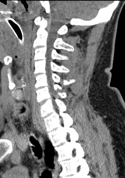 File:Cerebral hemorrhagic contusions and cervical spine fractures (Radiopaedia 32865-33841 G 64).jpg