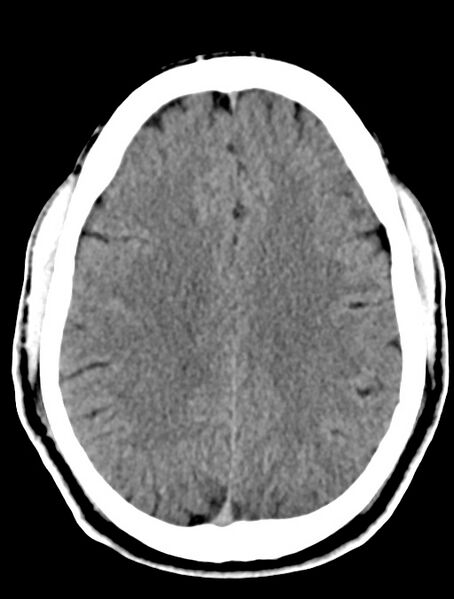 File:Cerebral venous angioma (Radiopaedia 69959-79977 Axial non-contrast 21).jpg