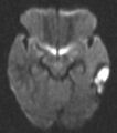 Cerebral venous infarction (Radiopaedia 10746-11206 Axial DWI 1).JPG