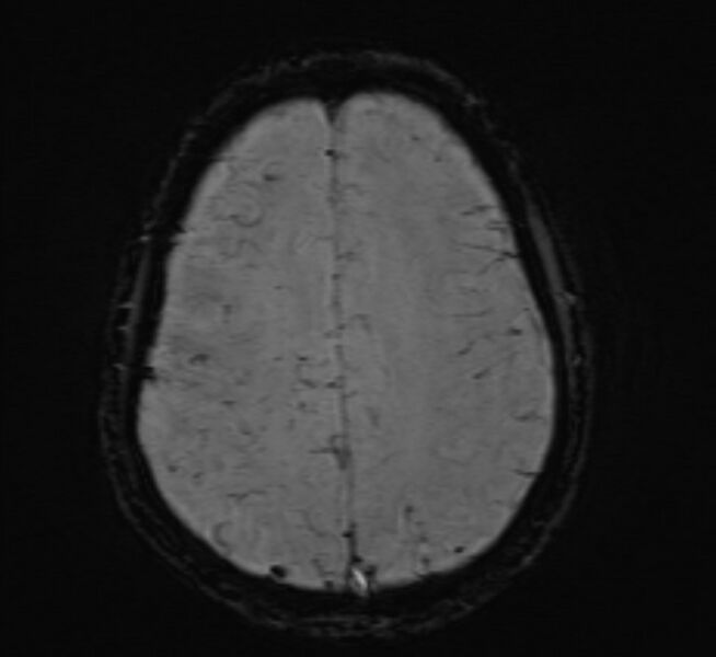 File:Cerebral venous thrombosis (Radiopaedia 71207-81504 Axial SWI 39).jpg