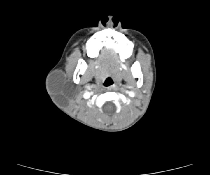 File:Cervical cystic lymphangioma (Radiopaedia 63655-72332 Axial + contrast 8).jpg