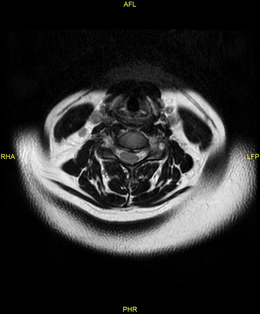 Cervical disc protrusion (Radiopaedia 87147-103415 Axial T2 18).jpg