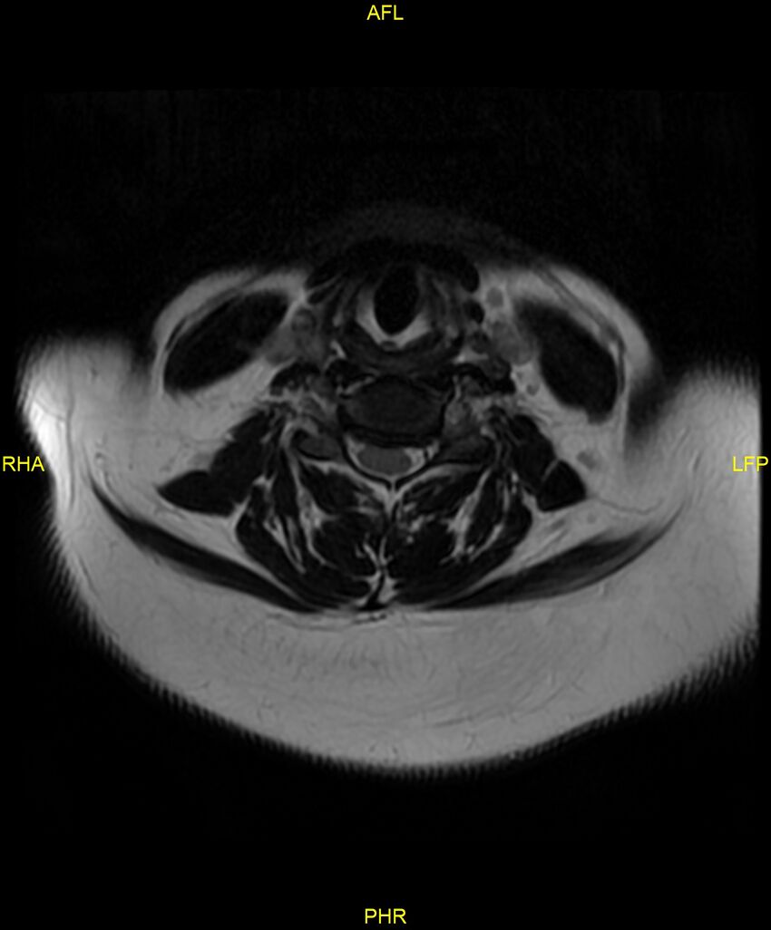 Cervical disc protrusion (Radiopaedia 87147-103415 Axial T2 25).jpg