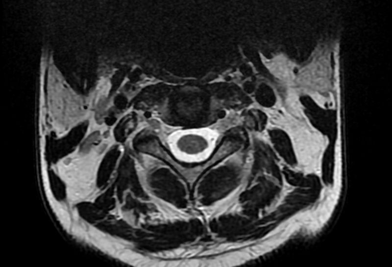 File:Cervical schwannoma (Radiopaedia 72399-82934 Axial T2 1).jpg