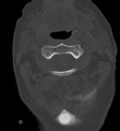 Cervical spine ACDF loosening (Radiopaedia 48998-54070 Axial bone window 18).png